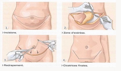 chirurgie esthetique ventre montpellier
